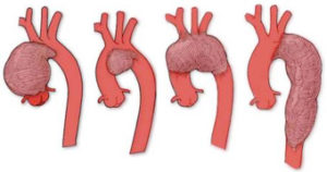 胸部大動脈瘤とは？