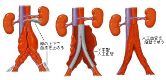 腹部大動脈瘤とは？