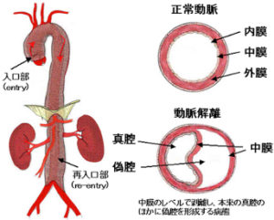 急性大動脈解離（解離性大動脈瘤）