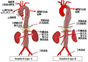 急性動脈解離の病態