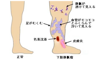 下肢静脈瘤とは