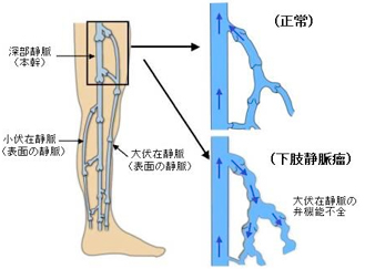 下肢静脈瘤の原因