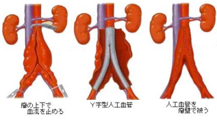 胸部及び腹部大動脈手術