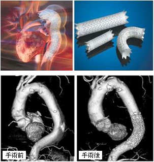 胸部大動脈瘤ステントグラフト