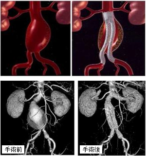 腹部大動脈瘤ステントグラフト