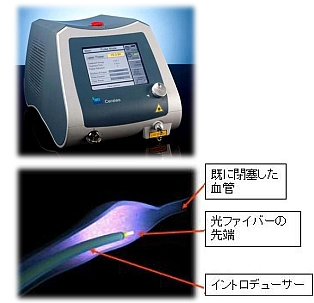 切らずに治す静脈瘤治療　血管内レーザー照射術(ELVeSレーザー治療)