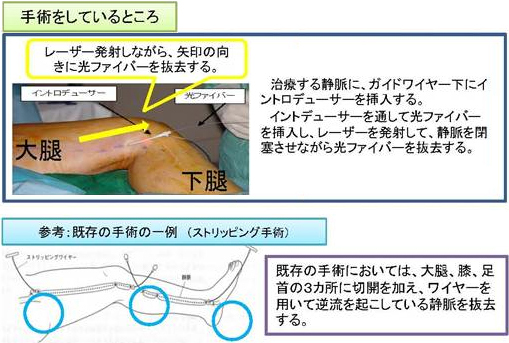 切らずに治す静脈瘤治療　血管内レーザー照射術(ELVeSレーザー治療)