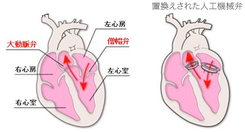 心臓弁膜症の外科的治療