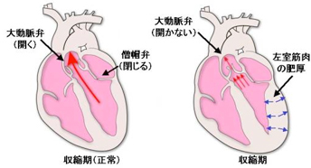 大動脈弁狭窄症