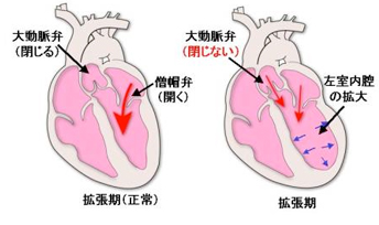 大動脈弁閉鎖不全症