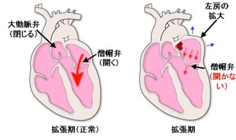 僧帽弁狭窄症