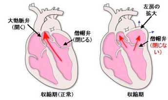 僧帽弁閉鎖不全症