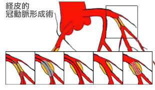 バイパス治療の必要性