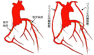 バイパス手術とは