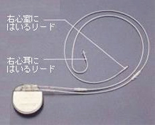 ペースメーカーの植込み方法