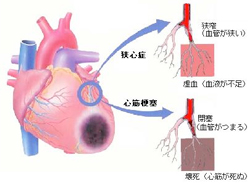 狭心症、心筋梗塞とは？