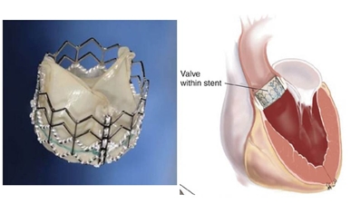 経カテーテル大動脈弁留置術（TAVI）とは？