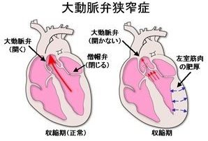 大動脈弁狭窄症