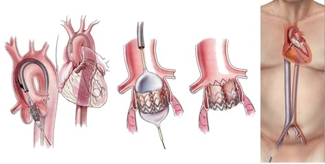 大腿動脈からのアプローチによるTAVI