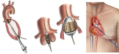 心尖アプローチによるTAVI