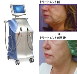 Vシェイプ