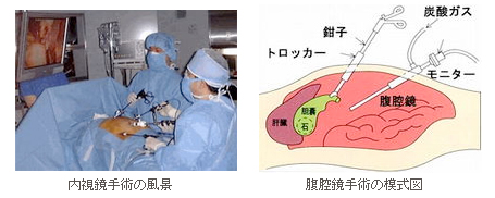 内視鏡下外科手術とは