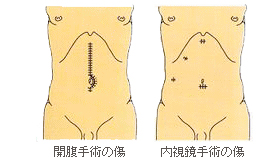 内視鏡下手術の利点と欠点