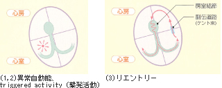 高周波カテーテルアブレーション