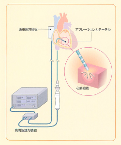 高周波カテーテルアブレーション