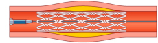 ステント治療