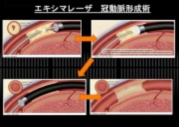 エキシマレーザー治療（ELCA）：高度先進医療