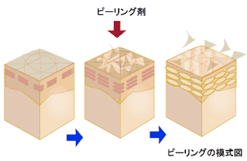 ピーリング模式図